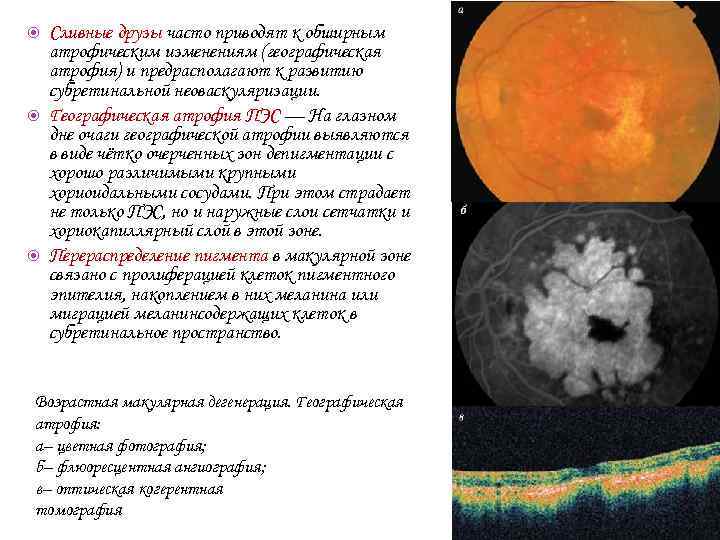  Сливные друзы часто приводят к обширным атрофическим изменениям (географическая атрофия) и предрасполагают к