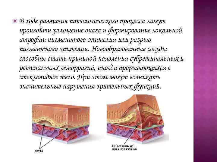  В ходе развития патологического процесса могут произойти уплощение очага и формирование локальной атрофии