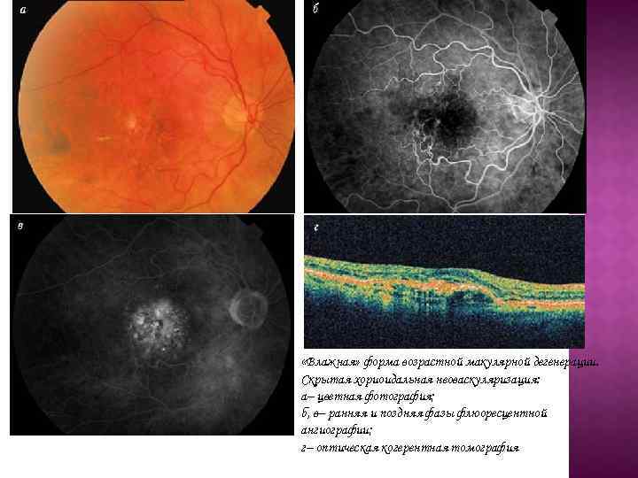 «Влажная» форма возрастной макулярной дегенерации. Скрытая хориоидальная неоваскуляризация: а– цветная фотография; б, в–