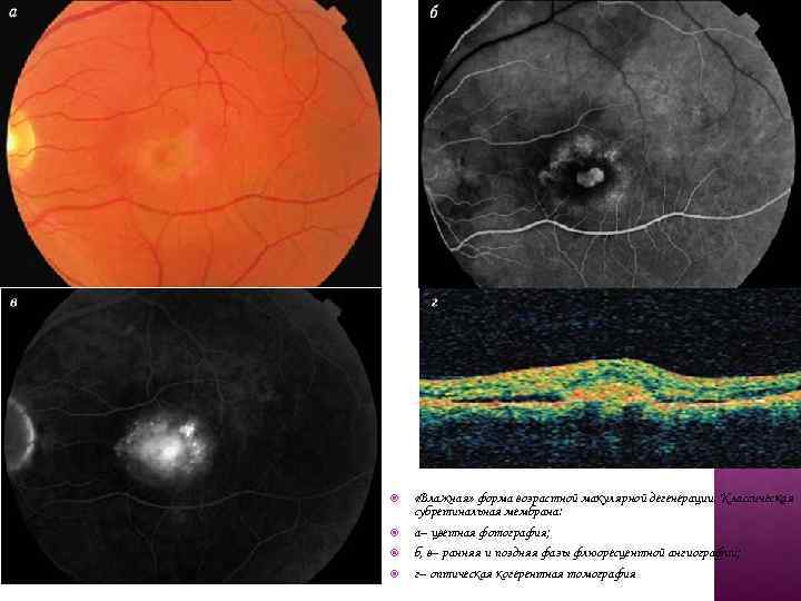  «Влажная» форма возрастной макулярной дегенерации. Классическая субретинальная мембрана: а– цветная фотография; б, в–