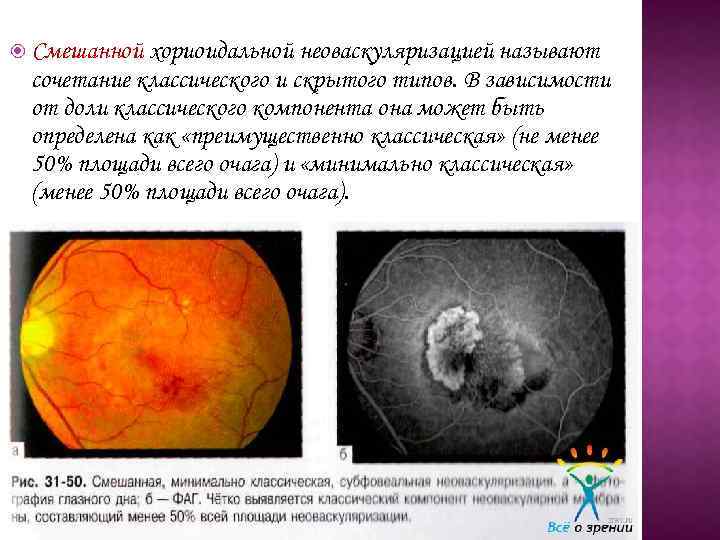  Смешанной хориоидальной неоваскуляризацией называют сочетание классического и скрытого типов. В зависимости от доли