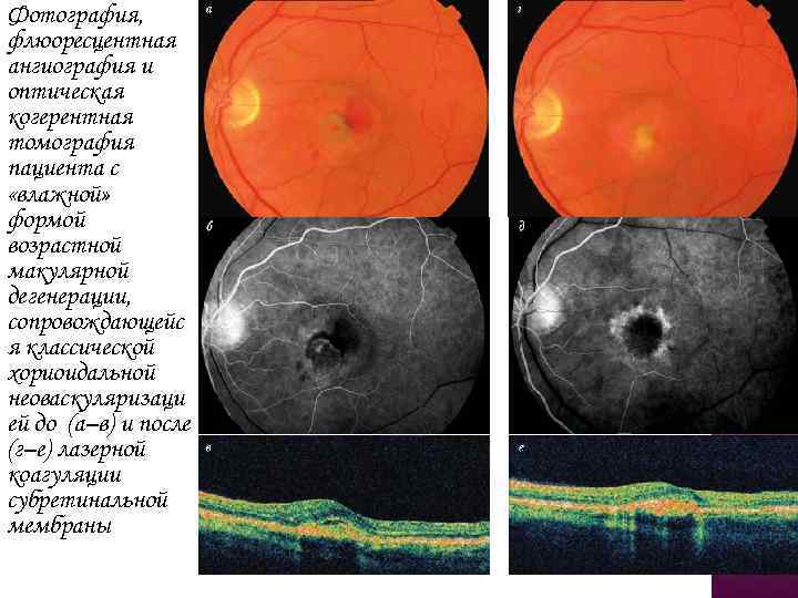 Фотография, флюоресцентная ангиография и оптическая когерентная томография пациента с «влажной» формой возрастной макулярной дегенерации,