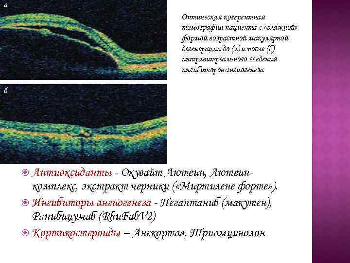 Оптическая когерентная томография пациента с «влажной» формой возрастной макулярной дегенерации до (а) и после
