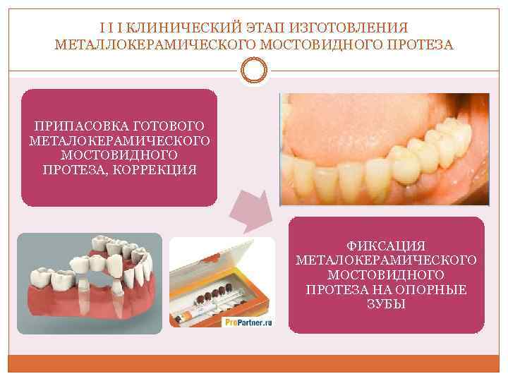 Изготовление мостовидных протезов презентация