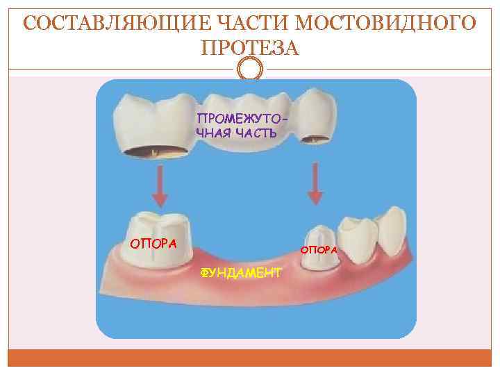 Части мостовидного протеза