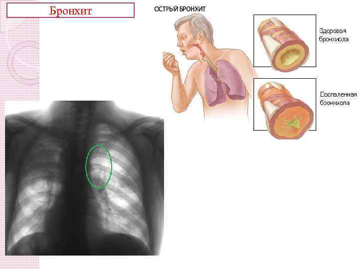 Бронхит 