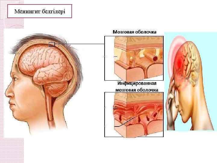 Менингит белгілері 