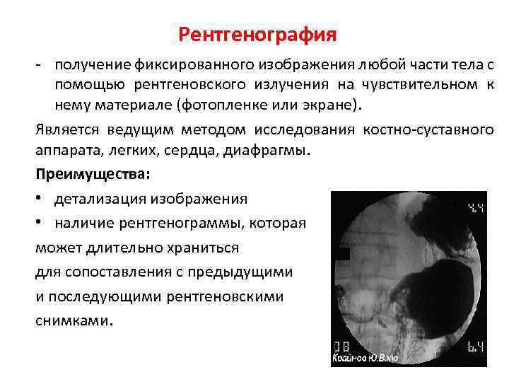 Рентгенография - получение фиксированного изображения любой части тела с помощью рентгеновского излучения на чувствительном