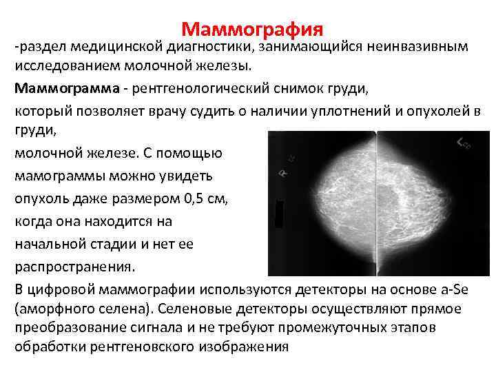 Маммография -раздел медицинской диагностики, занимающийся неинвазивным исследованием молочной железы. Маммограмма - рентгенологический снимок груди,