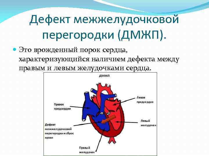 Дефект межжелудочковой перегородки (ДМЖП). Это врожденный порок сердца, характеризующийся наличием дефекта между правым и