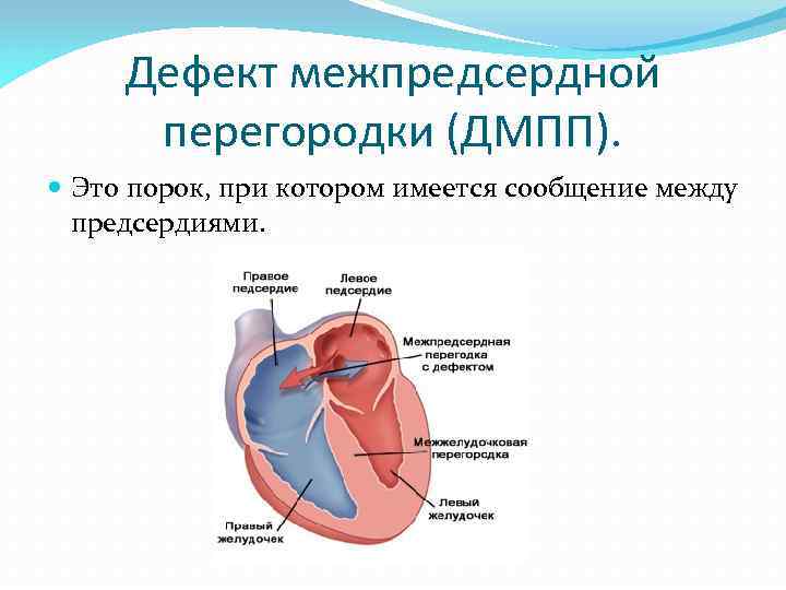 Дефект межпредсердной перегородки по утвержденным клиническим