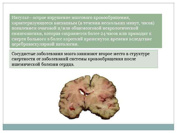 Инсульт– острое нарушение мозгового кровообращения, характеризующееся внезапным (в течении нескольких минут, часов) появлением очаговой