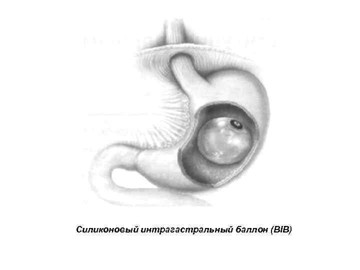 Силиконовый интрагастральный баллон (BIB) 