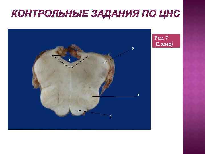 КОНТРОЛЬНЫЕ ЗАДАНИЯ ПО ЦНС Рис. 7 (2 мин) 