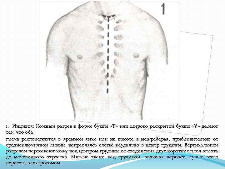 1. Инцизия: Кожный разрез в форме буквы «Т» или широко раскрытой буквы «У» делают