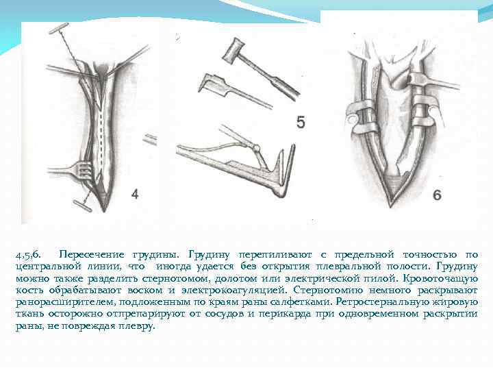 4, 5, 6. Пересечение грудины. Грудину перепиливают с предельной точностью по центральной линии, что