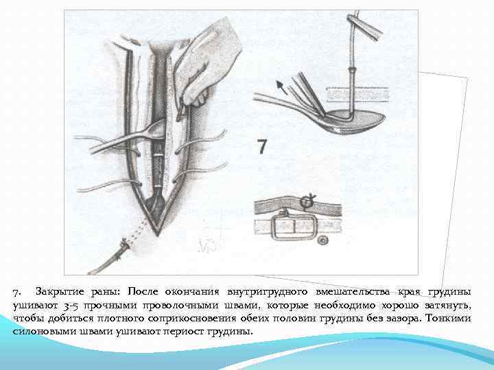 7. Закрытие раны: После окончания внутригрудного вмешательства края грудины ушивают 3 -5 прочными проволочными