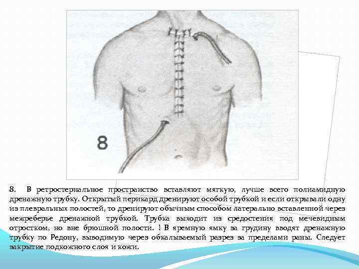 8. В ретростернальное пространство вставляют мягкую, лучше всего полиамидную дренажную трубку. Открытый перикард дренируют