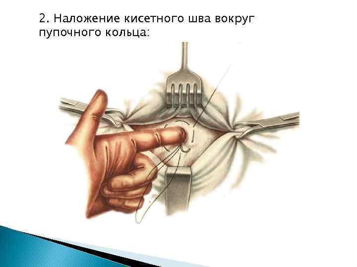 2. Наложение кисетного шва вокруг пупочного кольца: 