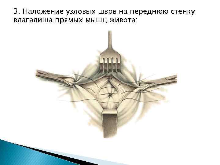 3. Наложение узловых швов на переднюю стенку влагалища прямых мышц живота: 