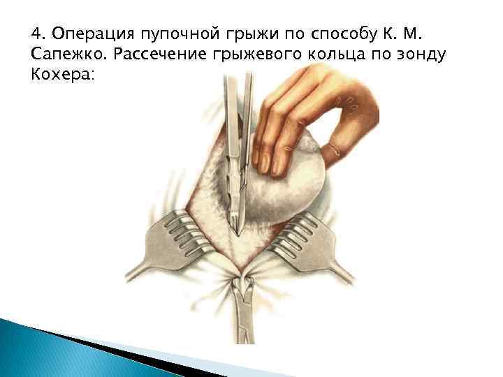 Герниопластика пупочной грыжи. Герниотомия пупочной грыжи. Операция по Сапежко пупочная грыжа. Операция по Сапежко грыжа.