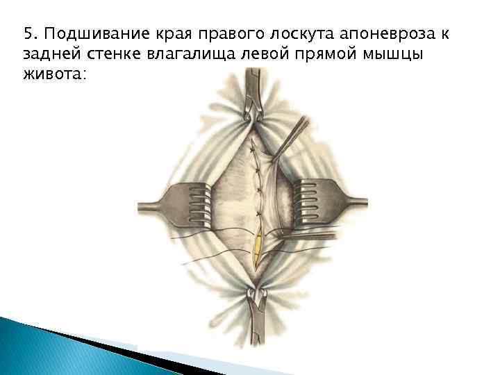 5. Подшивание края правого лоскута апоневроза к задней стенке влагалища левой прямой мышцы живота: