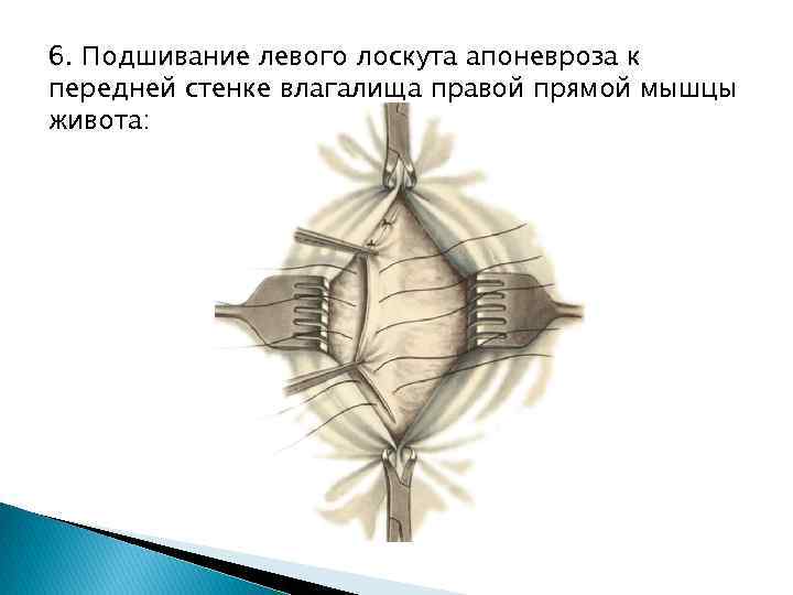 6. Подшивание левого лоскута апоневроза к передней стенке влагалища правой прямой мышцы живота: 