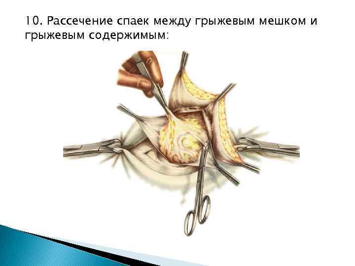 10. Рассечение спаек между грыжевым мешком и грыжевым содержимым: 