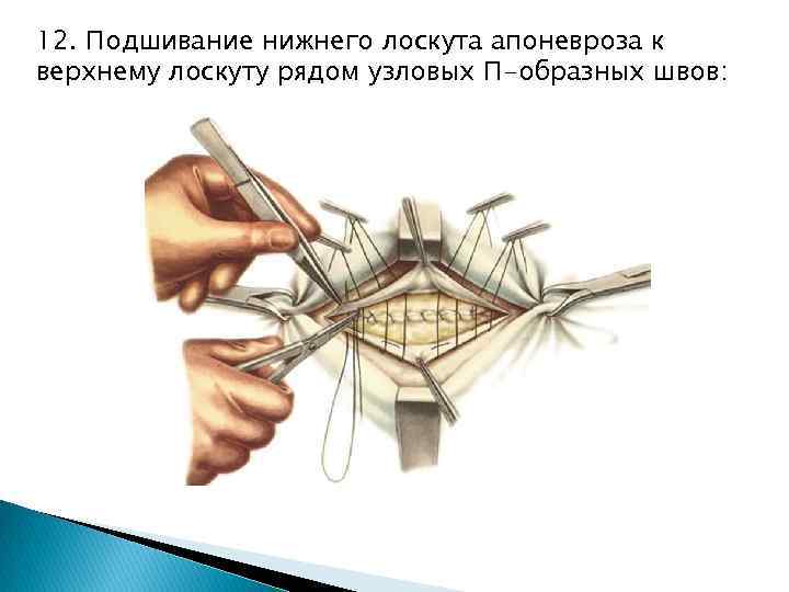 12. Подшивание нижнего лоскута апоневроза к верхнему лоскуту рядом узловых П-образных швов: 