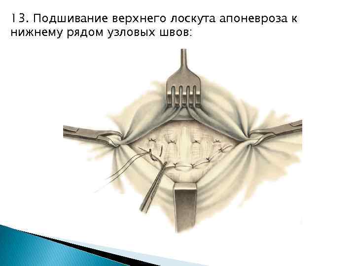 13. Подшивание верхнего лоскута апоневроза к нижнему рядом узловых швов: 