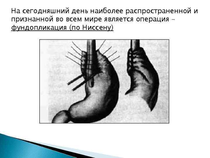 На сегодняшний день наиболее распространенной и признанной во всем мире является операция – фундопликация