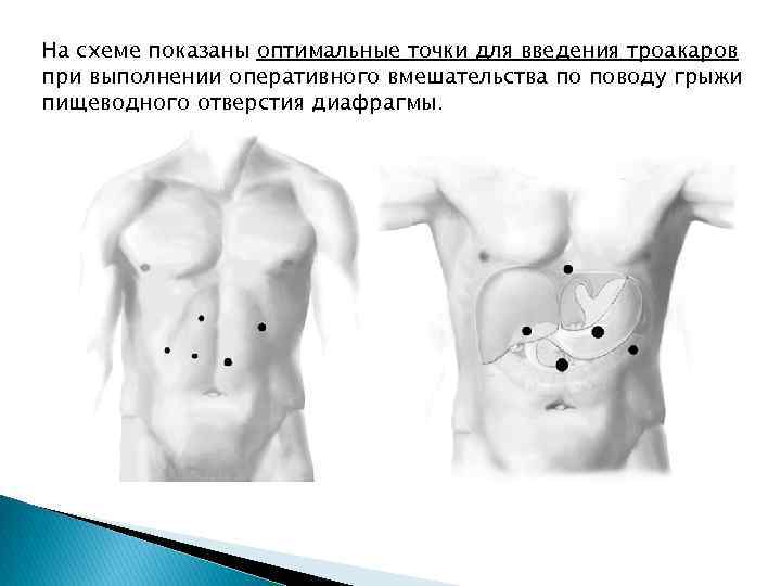 На схеме показаны оптимальные точки для введения троакаров при выполнении оперативного вмешательства по поводу