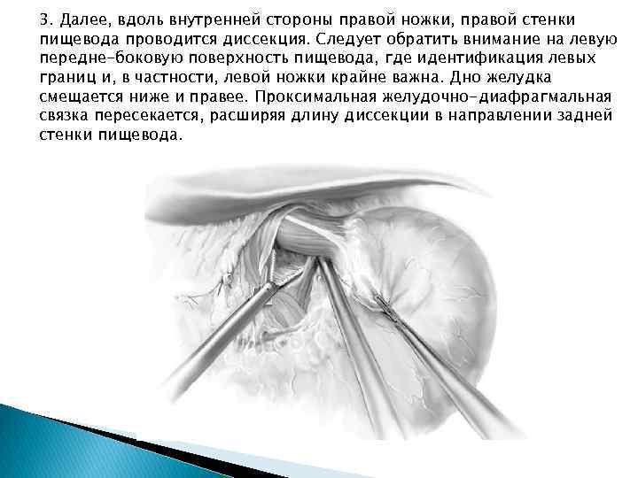 3. Далее, вдоль внутренней стороны правой ножки, правой стенки пищевода проводится диссекция. Следует обратить