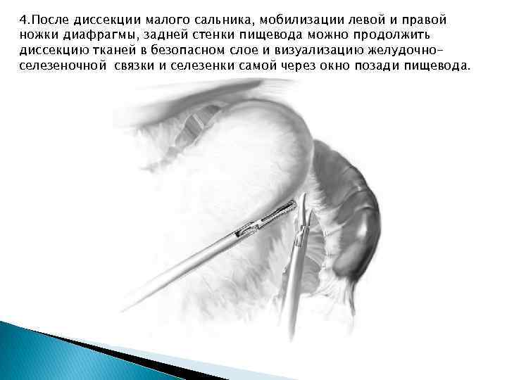 4. После диссекции малого сальника, мобилизации левой и правой ножки диафрагмы, задней стенки пищевода