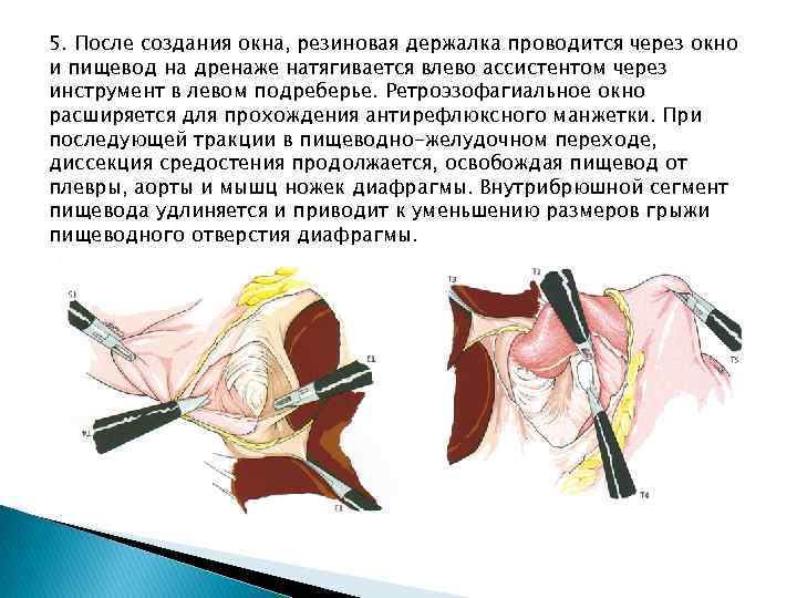 5. После создания окна, резиновая держалка проводится через окно и пищевод на дренаже натягивается