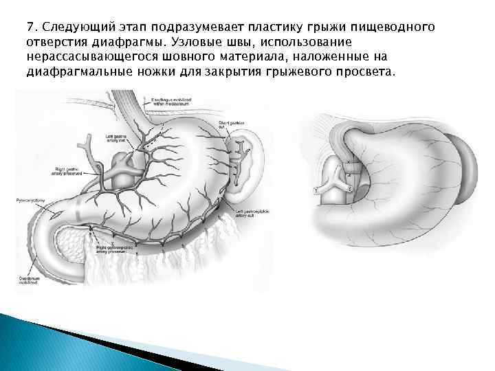 7. Следующий этап подразумевает пластику грыжи пищеводного отверстия диафрагмы. Узловые швы, использование нерассасывающегося шовного