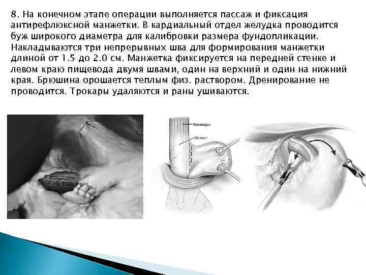 8. На конечном этапе операции выполняется пассаж и фиксация антирефлюксной манжетки. В кардиальный отдел
