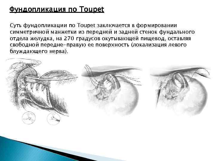 Фундопликация по Toupet Суть фундопликации по Toupet заключается в формировании симметричной манжетки из передней