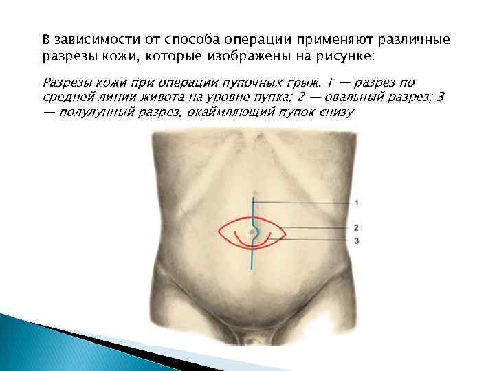 В зависимости от способа операции применяют различные разрезы кожи, которые изображены на рисунке: Разрезы