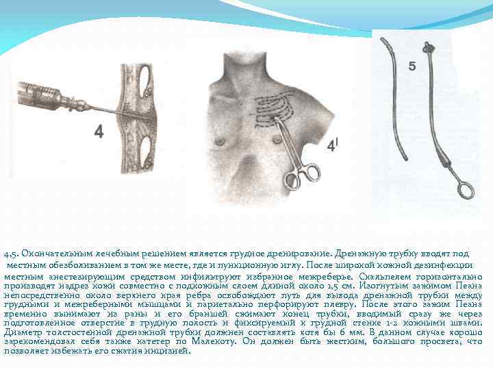 4, 5. Окончательным лечебным решением является грудное дренирование. Дренажную трубку вводят под местным обезболиванием