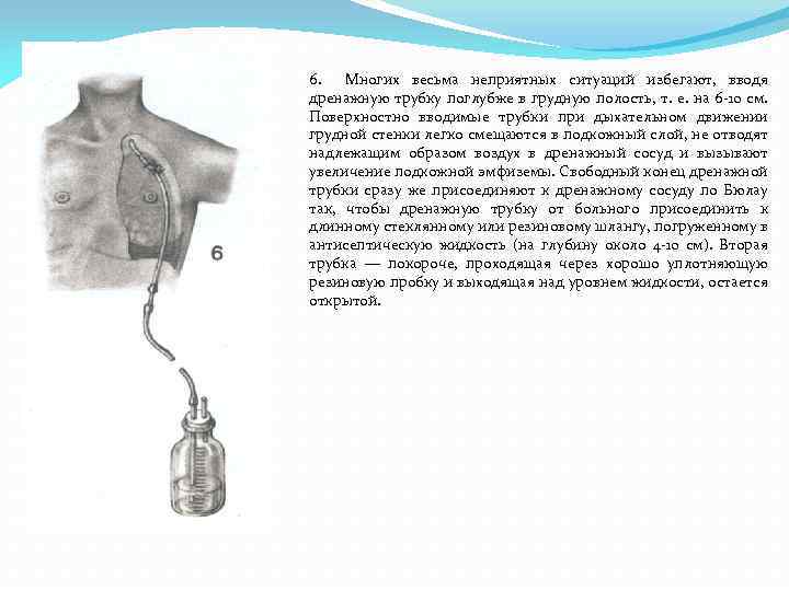 6. Многих весьма неприятных ситуаций избегают, вводя дренажную трубку поглубже в грудную полость, т.