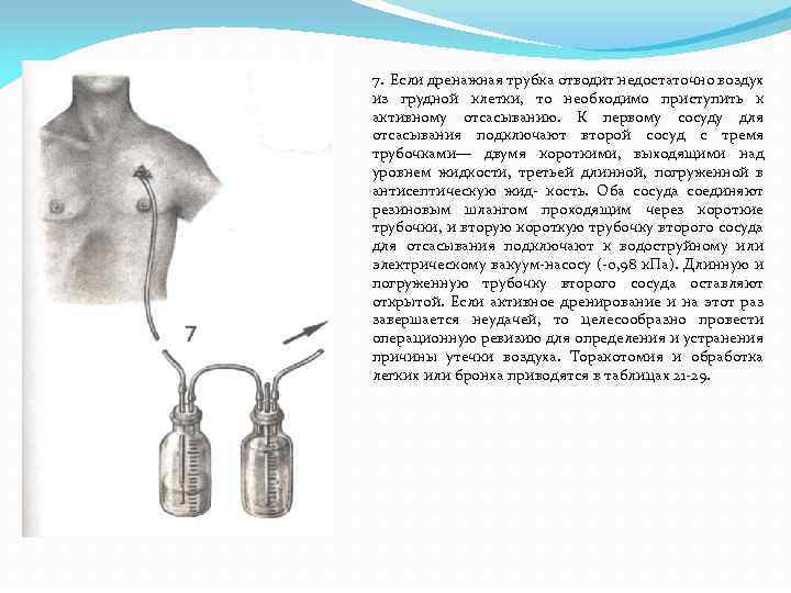 7. Если дренажная трубка отводит недостаточно воздух из грудной клетки, то необходимо приступить к