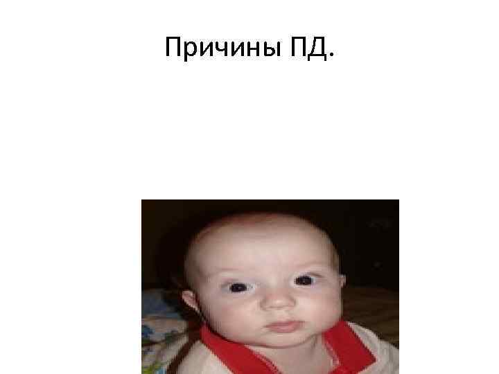 Причины ПД. 