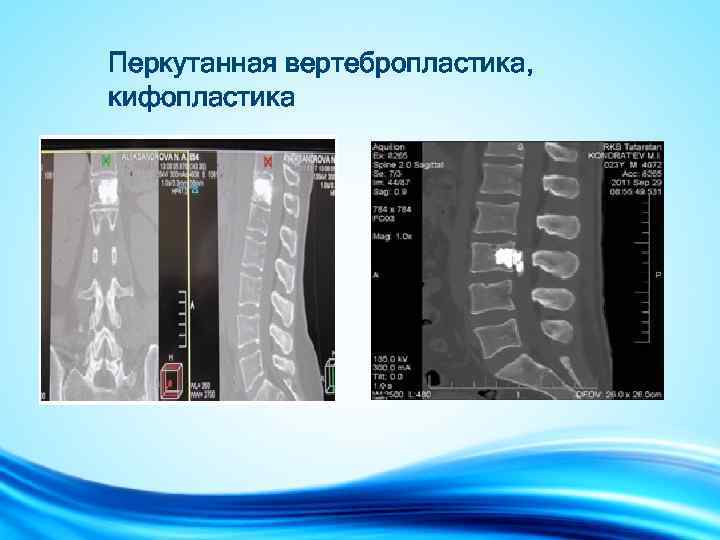 Перкутанная вертебропластика, кифопластика 