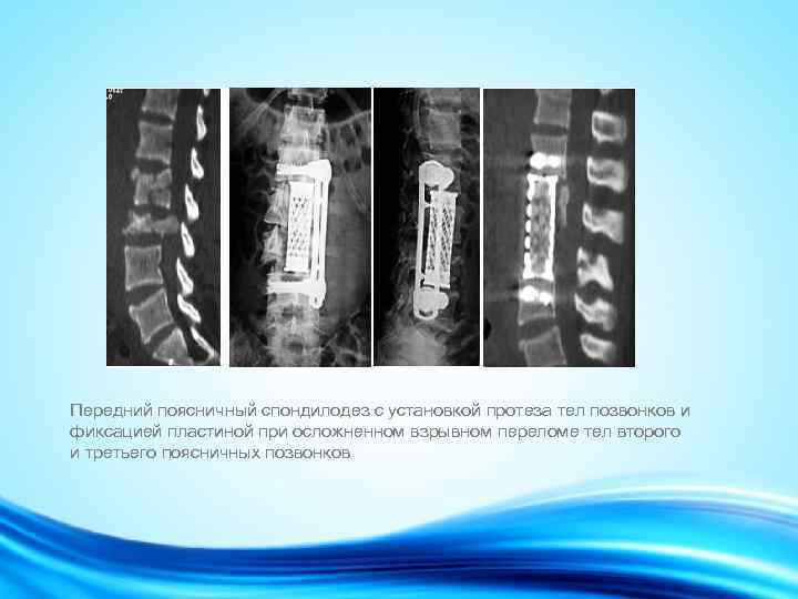 Передний поясничный спондилодез с установкой протеза тел позвонков и фиксацией пластиной при осложненном взрывном