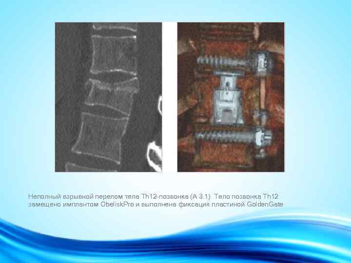 Неполный взрывной перелом тела Th 12 -позвонка (А 3. 1). Тело позвонка Th 12