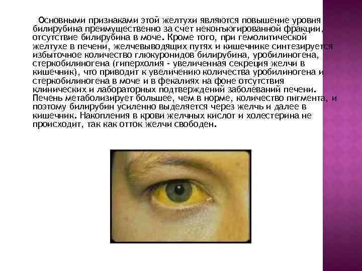 Желтуха симптомы у детей. Проявление надпеченочной желтухи. Надпеченочная (гемолитическая) желтуха. Глаза при механической желтухе. Механическая желтуха симптомы.