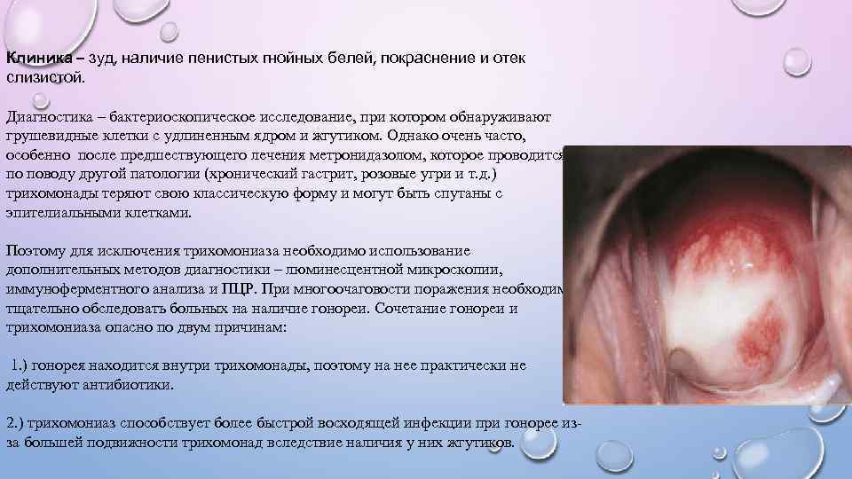 Клиника – зуд, наличие пенистых гнойных белей, покраснение и отек слизистой. Диагностика – бактериоскопическое