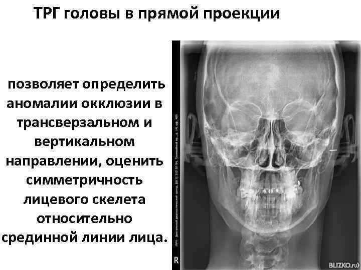 ТРГ головы в прямой проекции позволяет определить аномалии окклюзии в трансверзальном и вертикальном направлении,