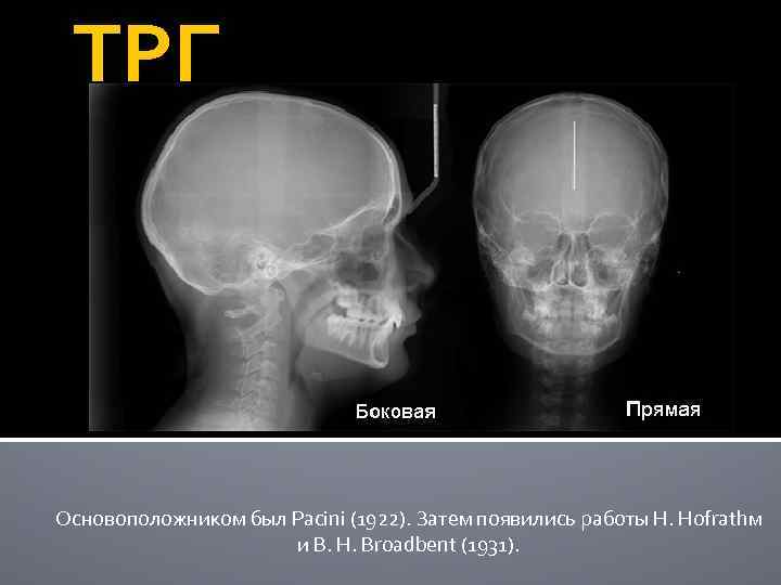ТРГ Основоположником был Pacini (1922). Затем появились работы Н. Hofrathм и В. Н. Broadbent